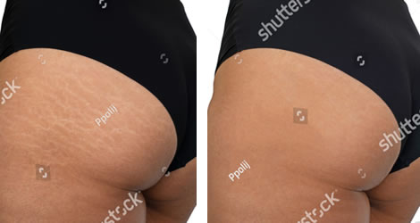stretch marks before after